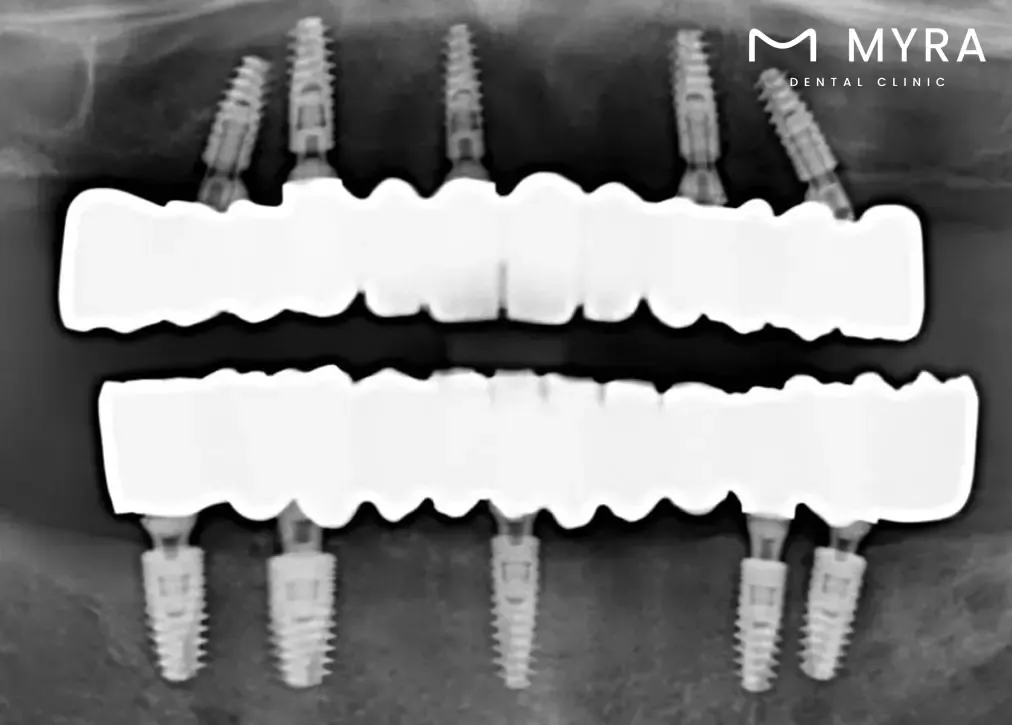 All-on-4 Dental Implants in Turkey- Cost, Pros, and Cons at Myra Dental Centre.webp